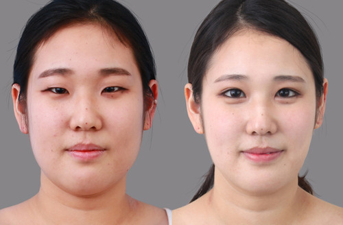 eyelid plastic surgery cost