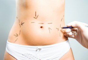 Liposuction Hawaii